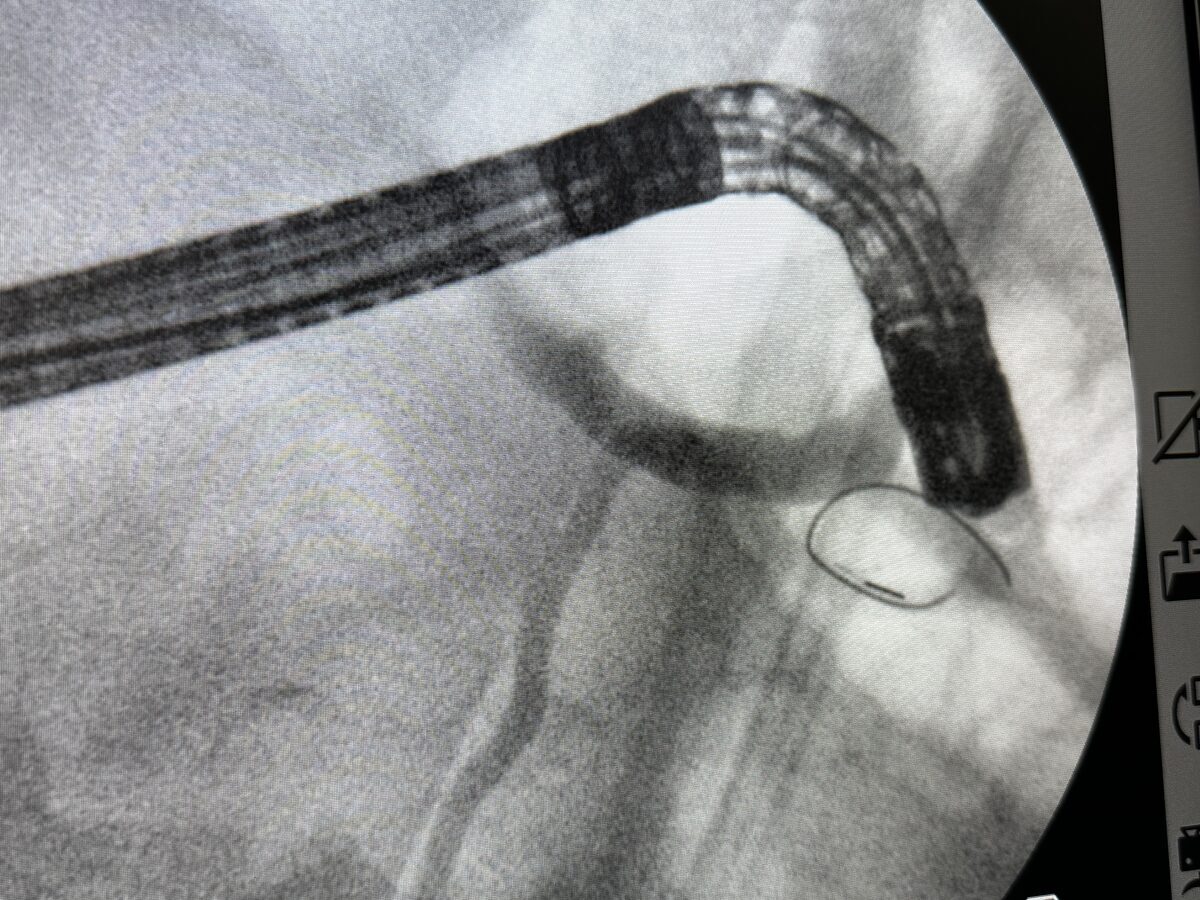Imagem de fluoroscopia durante procedimento de CPRE